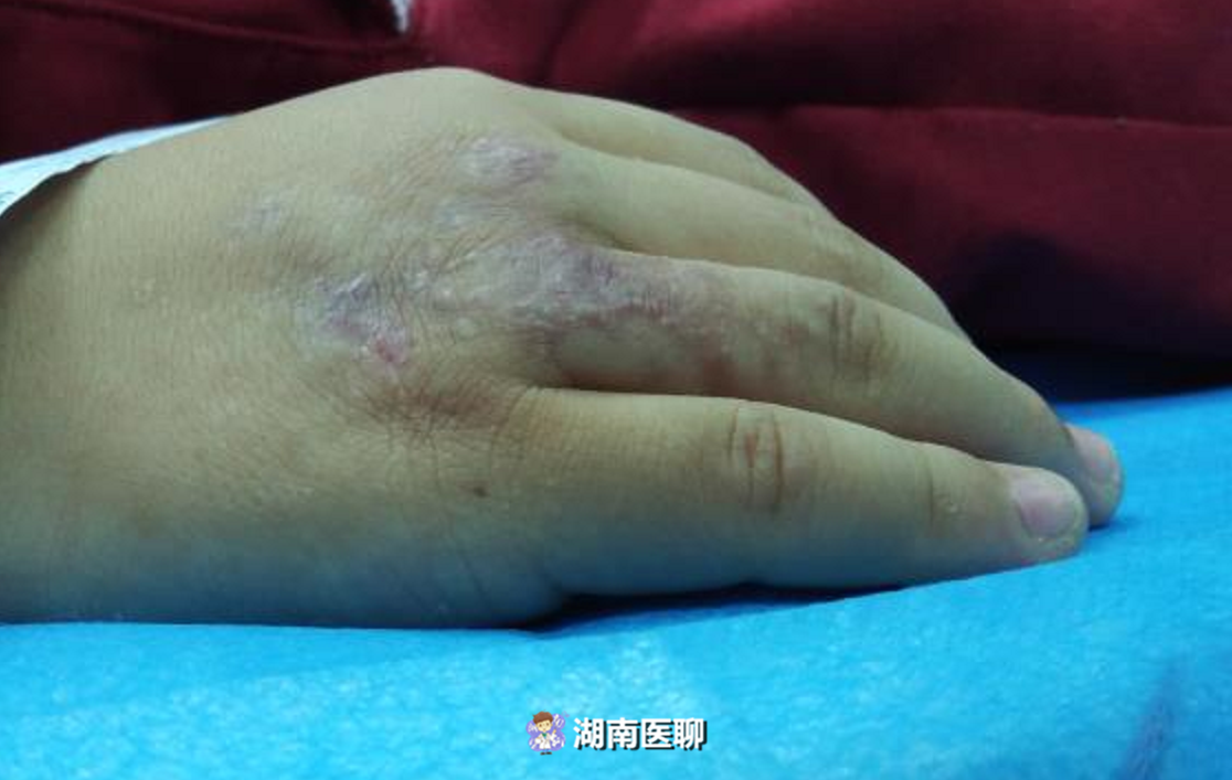手背静脉血管瘤图片图片