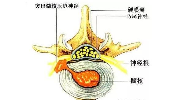 告别,腰椎间盘突出!这套康复锻炼,一天一次,坚持半个月!