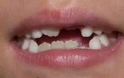 小孩子牙齿为什么会不整齐呢?