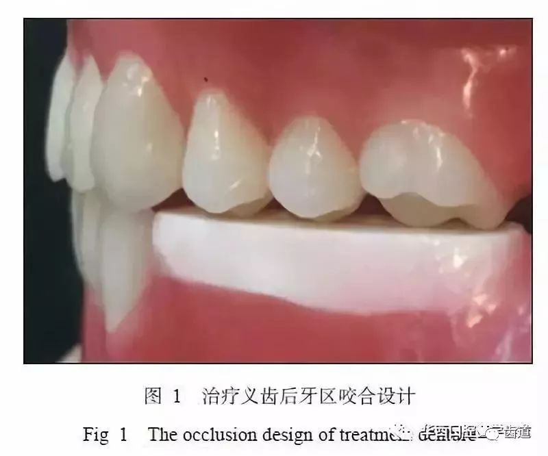 為患者製作治療義齒時,治療義齒與常規總義齒最大的區別在於後牙區