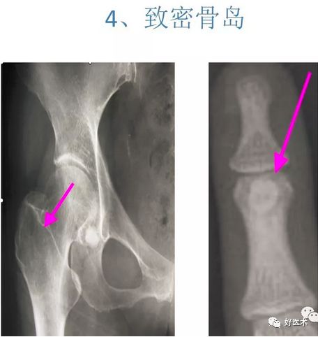 部分軟骨保持原態而不鈣化,此種遺留於骨內軟骨,在x線表現為在正常骨