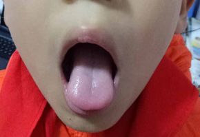 不会看宝宝的舌苔,还怎么带孩子?马上让你秒懂舌诊!