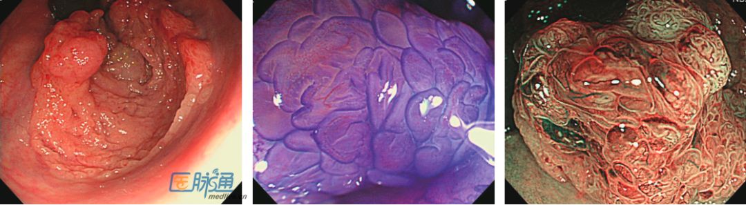 结直肠癌癌前病变的内镜特征