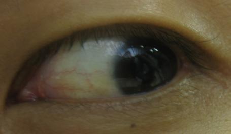 这个时候就会出现黄疸,而黄疸最典型症状就是眼睛发黄,有的甚至脸上也
