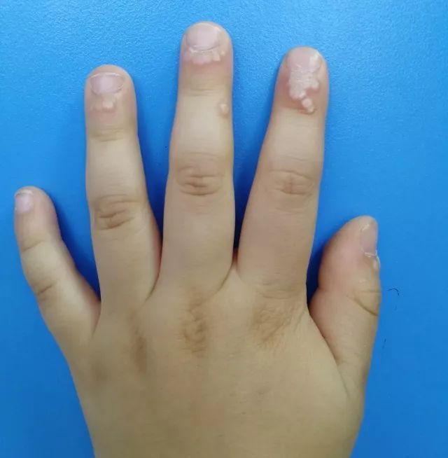 手指疣小孩子图片