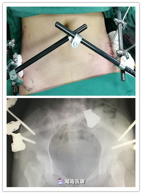 临床上一般骨盆前环不稳定骨折多以外固定架或切开复位内固定手术为主