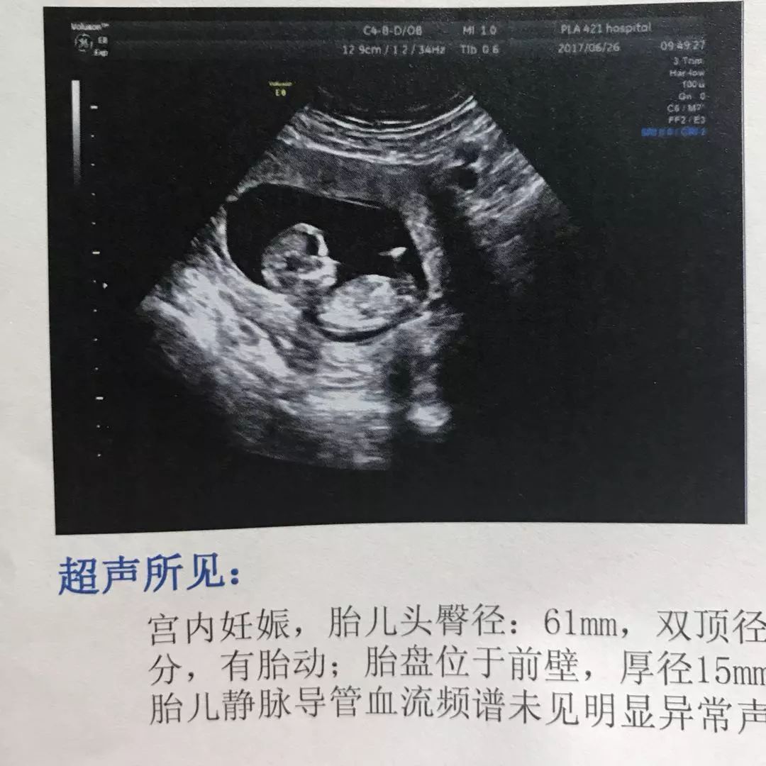 正常胎儿和唐氏儿四维图片