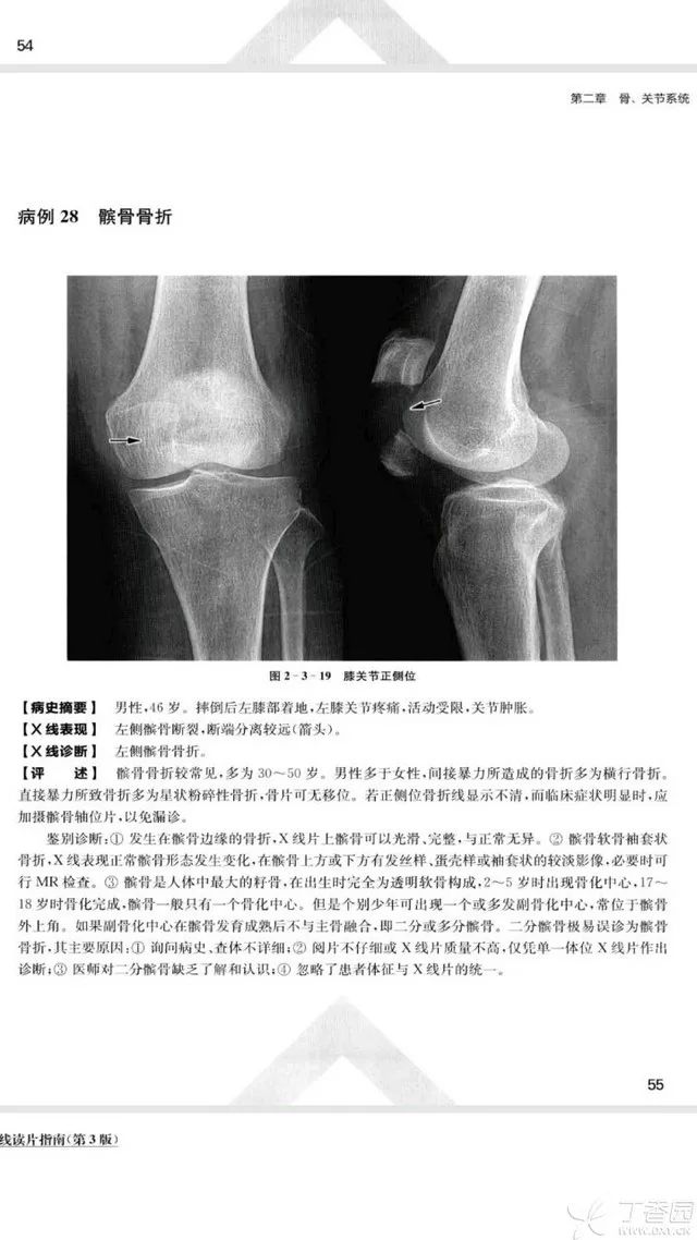 膝关节侧位片解剖图片