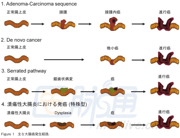 結直腸癌癌前病變的內鏡特徵-搜狐大視野-搜狐新聞