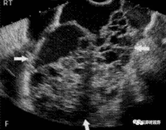 卵巢病变的超声诊断