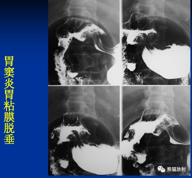 x线诊断要点丨慢性胃炎胃溃疡