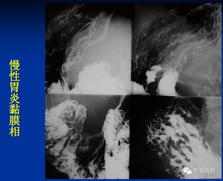 x线诊断要点丨慢性胃炎胃溃疡