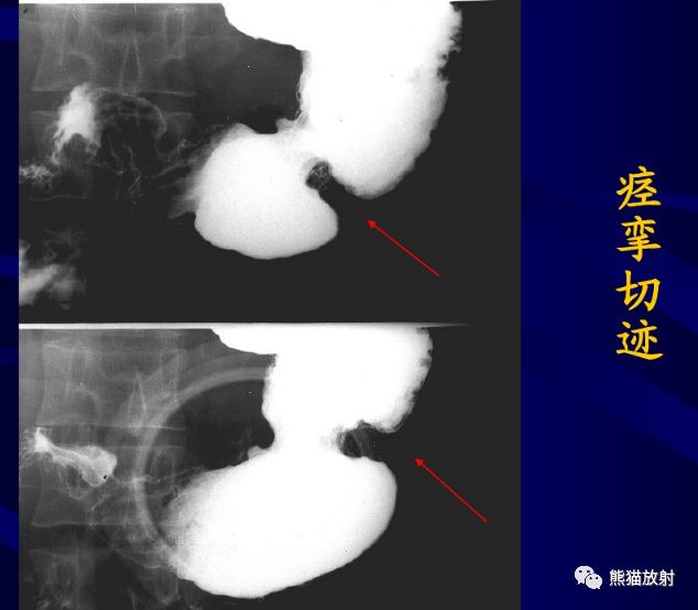 x线诊断要点丨慢性胃炎胃溃疡