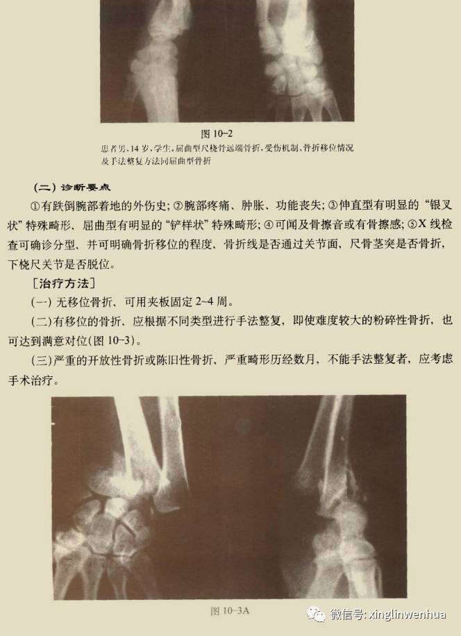 桡骨远端骨折报告图片