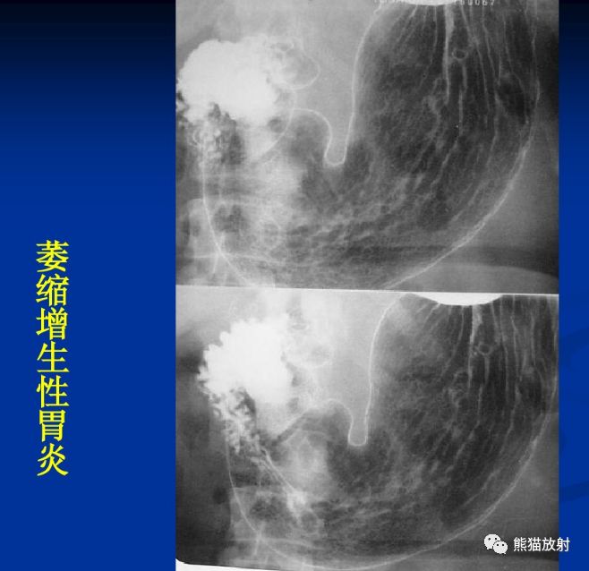 x线诊断要点丨慢性胃炎胃溃疡