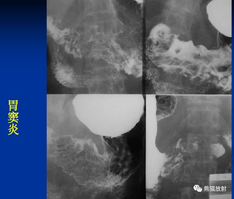 x线诊断要点丨慢性胃炎胃溃疡