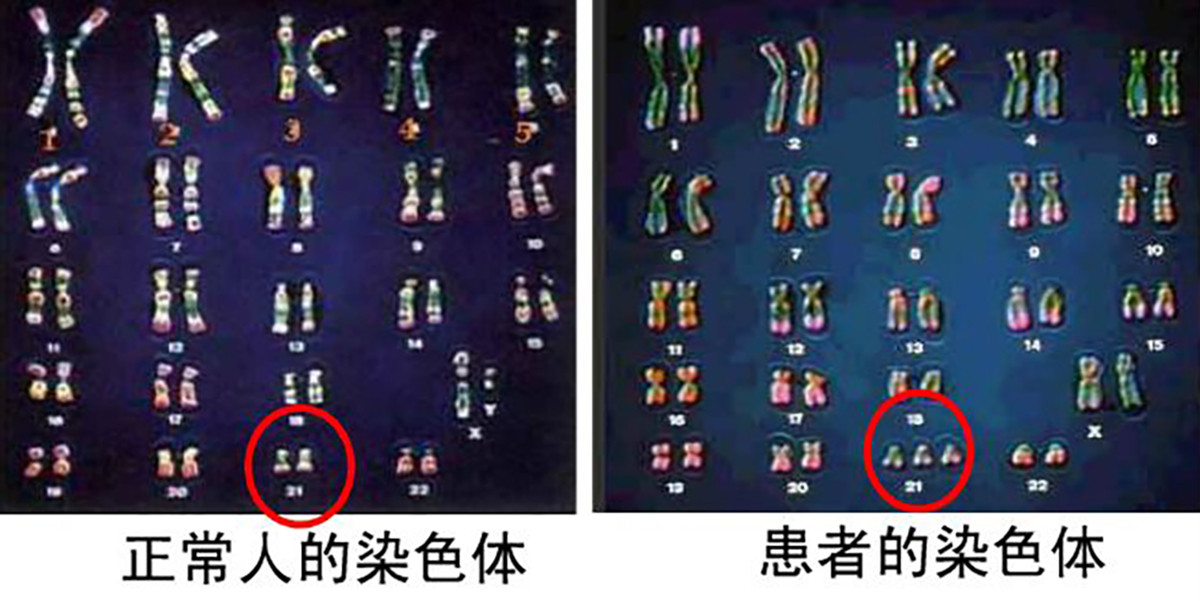 13三体综合征染色体图片