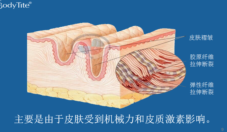 妊娠紋是(striaegravidarum)膨脹紋的一種,大多發生於懷孕期間,表現為