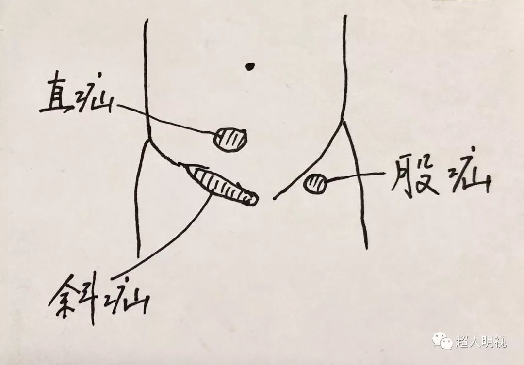 一目了然法—腹股沟韧带周围几个疝的区别