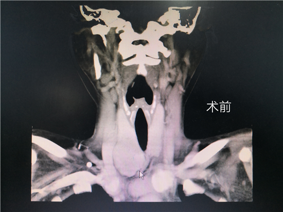 淮安市二院成功開展3d腔鏡經口腔甲狀腺手術無疤痕創傷小恢復快