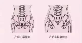 有多少女人因為骨盆沒修復而耽誤了後半生