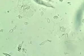 阴道霉菌(白色念珠菌):镜检可以看到较多芽孢和细长的菌丝阴道白色