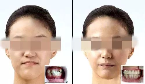 牙齿排列不齐,错位的,影响了脸型,经过牙齿矫正调整咬合,矫治结束后