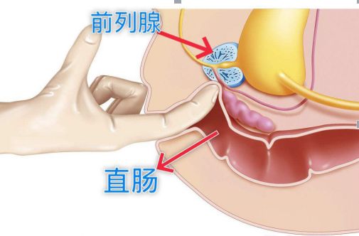 因为前列腺跟直肠的位置关系是这样的 前列腺指检