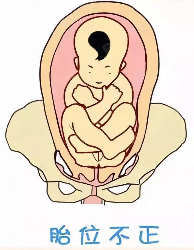 转胎位的姿势图图片