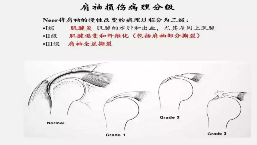 肩袖损伤的四个表现图片