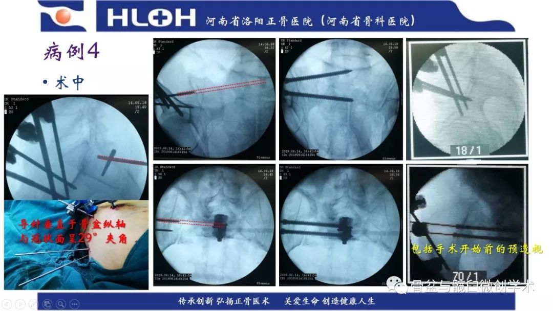 骶髂螺钉进针点图片图片