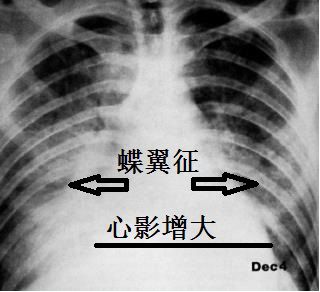 肺门蝴蝶状阴影图片