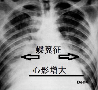 "蝶翼征"都是心衰肺水肿?不,还要和这些病鉴别!