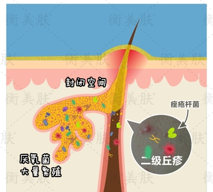 痘痘反覆去不掉?你一直用錯了方法了