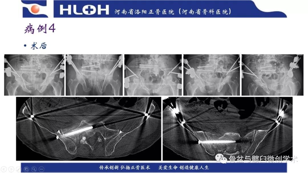 参会ppt 圆锥投影理论指导下的术前计划助力骶1骶髂螺钉导针指向调整