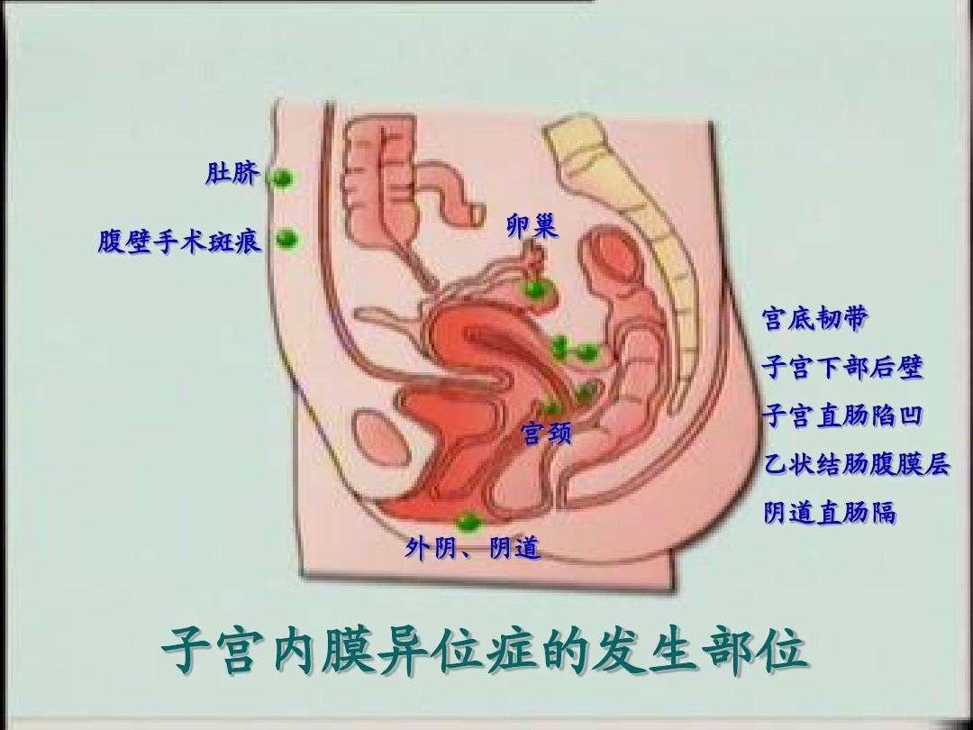 被称为良性的癌症的妇科疾病——子宫内膜异位症