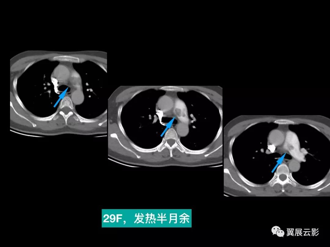 【经典回顾】肺栓塞影像诊断与鉴别