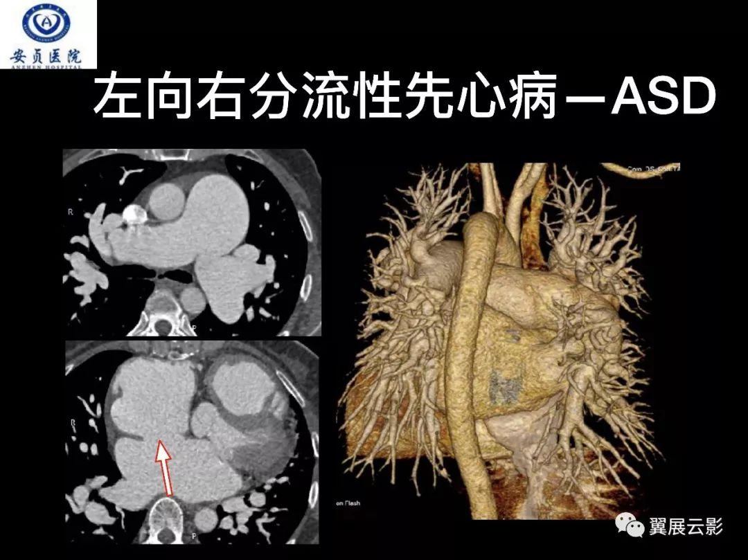 經典回顧肺栓塞影像診斷與鑑別