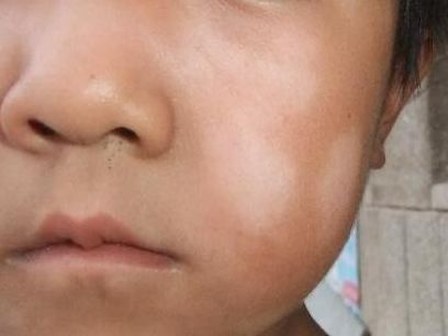 积食斑儿童脸部图片图片