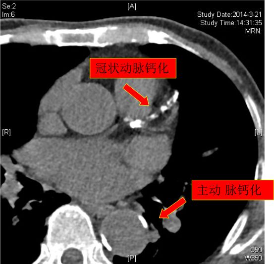 图3主动脉及冠状血管钙化4