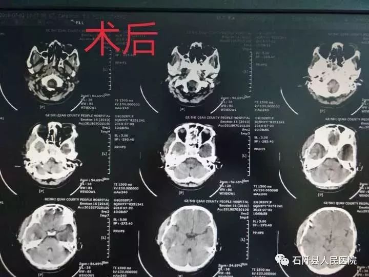 意識障礙加深,左側肢體偏癱,急診行頭部ct複查顯示右側顳葉腦內血腫