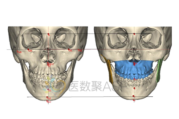 右側升支模擬截骨左側升支模擬截骨,去幹涉【產品規劃】中間咬合板