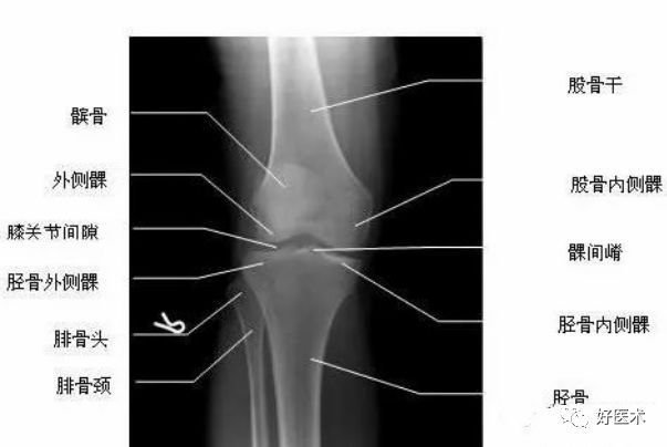 超详细的膝关节x线解剖及测量基础必备