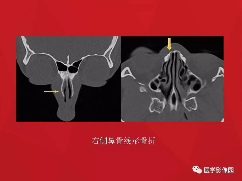 鼻骨骨折影像学诊断与鉴别 