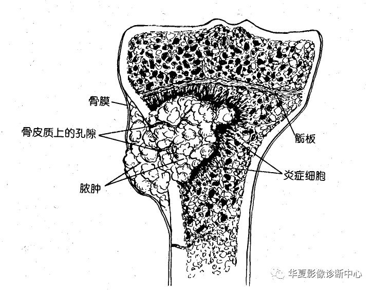 骨髓怎么读图片