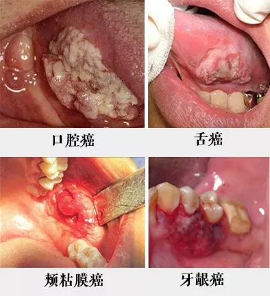 口腔疱疹初期图片