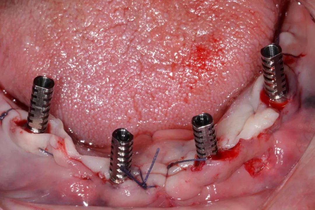 12)戴入下頜臨時全口義齒,該義齒已經按照種植導板在種植位置開4個孔