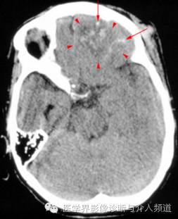(ct表現為左側額葉腦挫傷,具體為片狀低密度區內可見多發的高密度出血