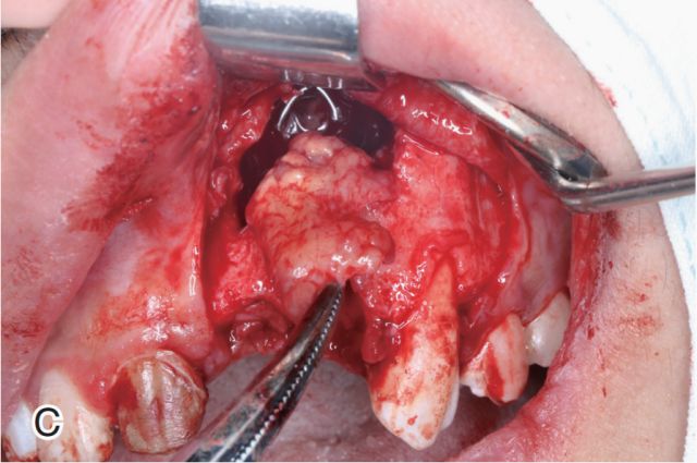 颌骨囊肿中牙和骨组织的处理对策王恩博医师