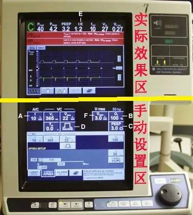 呼吸機菜鳥入門系列丨重要參數設置及ac模式